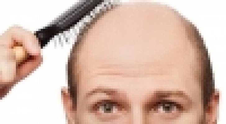 تقنية جديدة لزرع الشعر ومكافحة الصلع