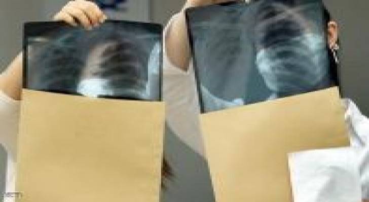 إسبانيا : أول عملية لزرع قفص صدري "مطبوع"