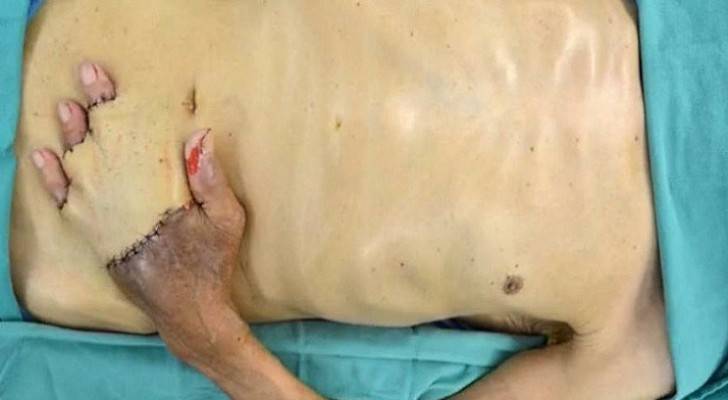 عملية جراحية غريبة تنقذ يد أمريكي من البتر