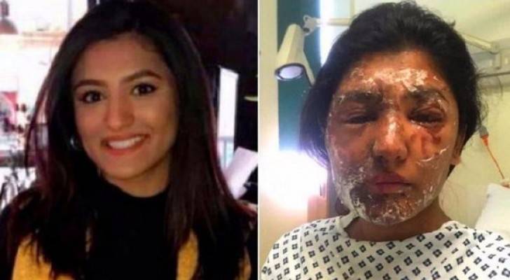 حرق وجه مسلمة وقريبها في لندن بأسيد الكبريت