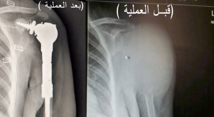 نتائج متميزة لعملية زراعة مفصل الكتف في الخدمات الطبية الملكية