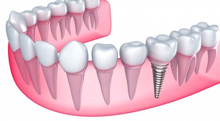 تحذير من زرعات أسنان "اسرائيلية" في السوق الأردنية