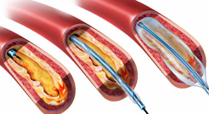 تعرف على أعراض الإصابة بـ "تصلب الشرايين" - فيديو