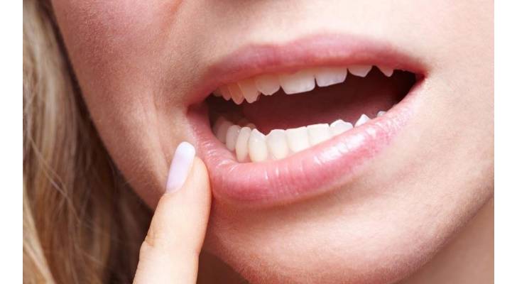 علامة تحذيرية تشير إلى مرض سرطان الفم القاتل
