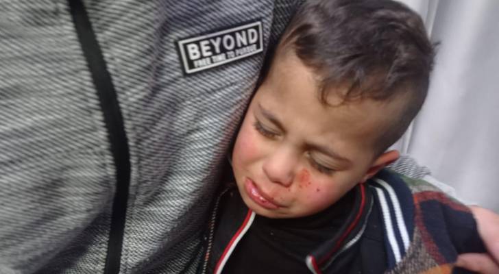 مستوطنون يصيبون طفلا فلسطينيا "٣ سنوات" بجروح في وجهه