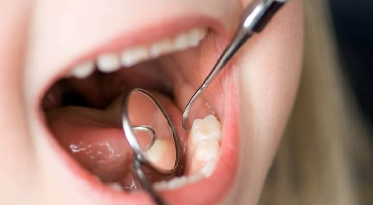 تغيير في قواعد اللعبة.. علاج مبتكر لتسوس الأسنان