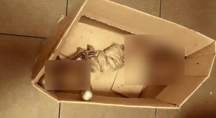القدم بترت نتيجة عملية جراحية