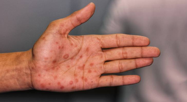 فيروس كورونا.. اكتشاف أعراض تظهر على الجلد