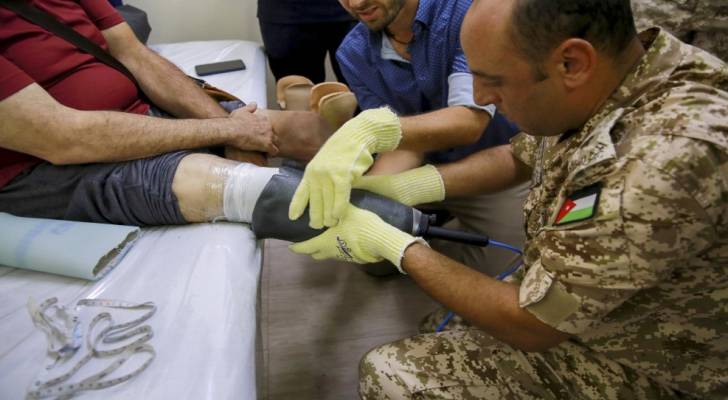 تركيب طرف صناعي لطفل من غزة