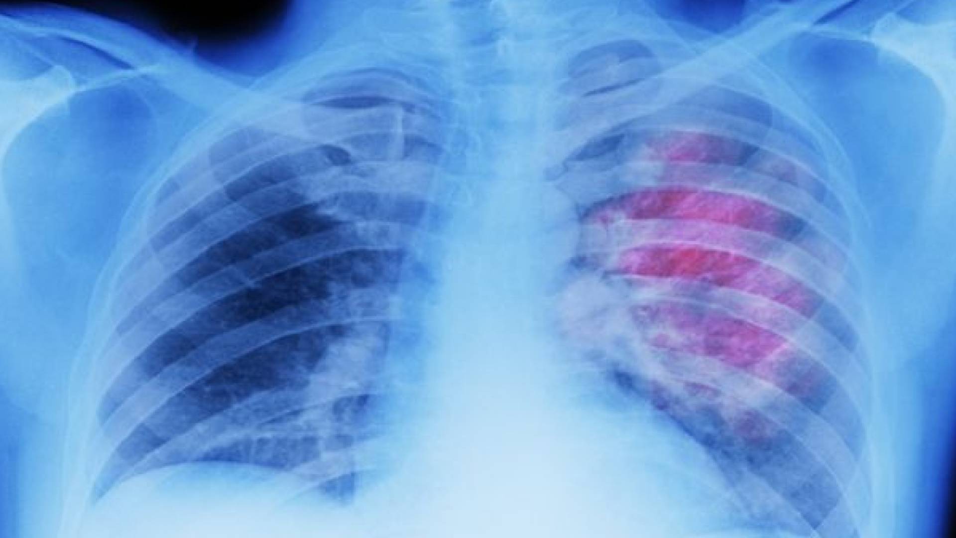 استشاري أمراض صدرية يحذر من الأثر "الكيميائي المدمر" لغاز الأمونيا على الرئتين