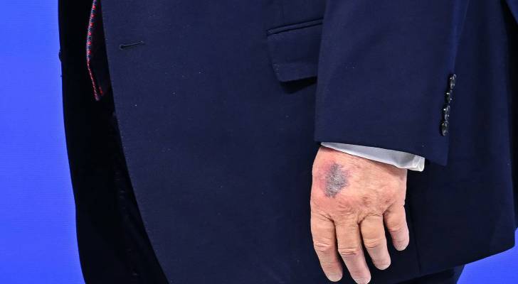 الكدمة الزرقاء على يد ترمب