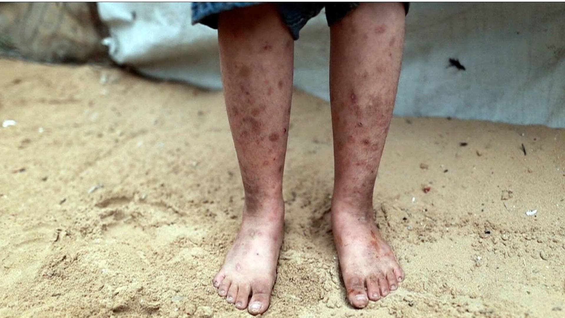 تحذير أممي: القوارض والأوبئة الجلدية تغزو خيام النازحين في قطاع غزة