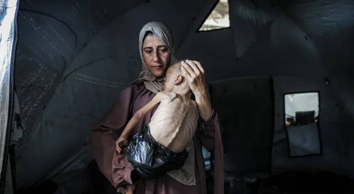 طفل فلسطيني يعاني سوء تغذية حاد