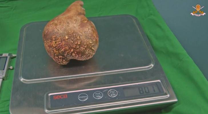 Sri Lanka doctors remove 'world's largest kidney stone'