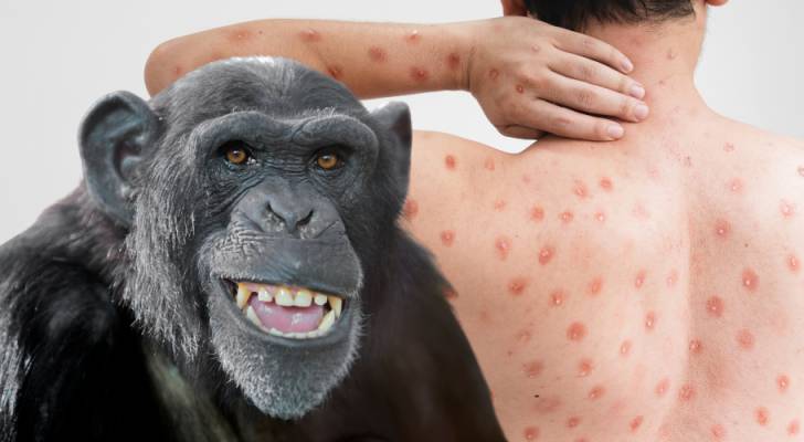 Health Ministry addresses Monkeypox concerns amid rising number of global cases