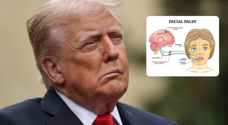 Did Donald Trump have a stroke?