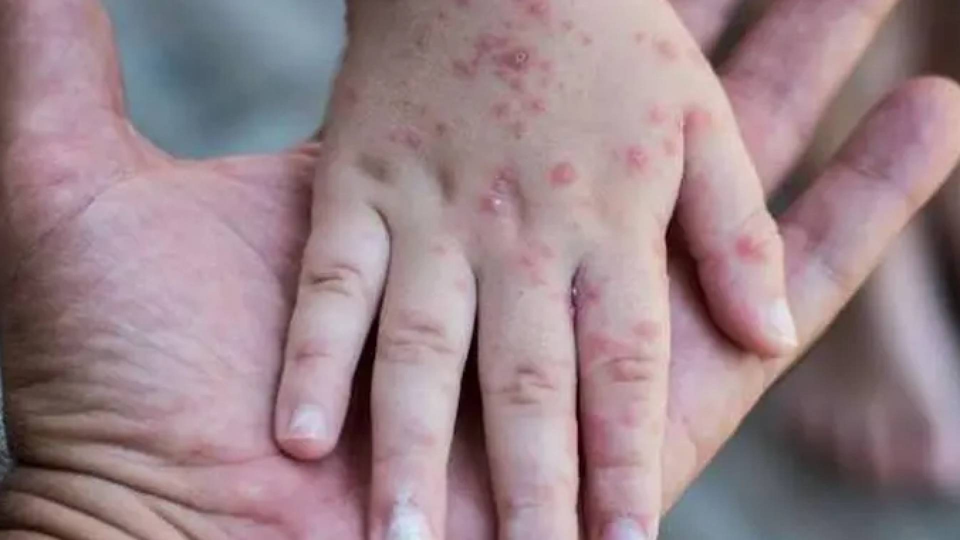 وزارة الصحة: مطعوم الجدري المائي يحمي بنسبة 97% وسيبدأ تقديمه للمواليد في 9 أيار