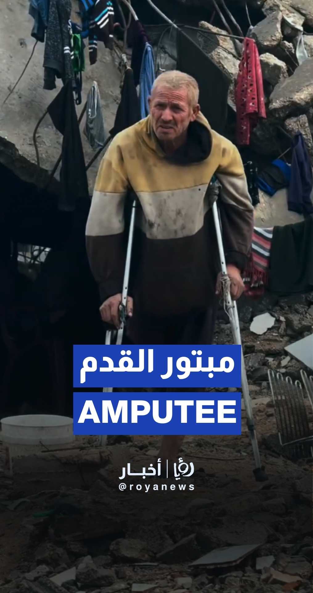 جريح فلسطيني مبتور القدم